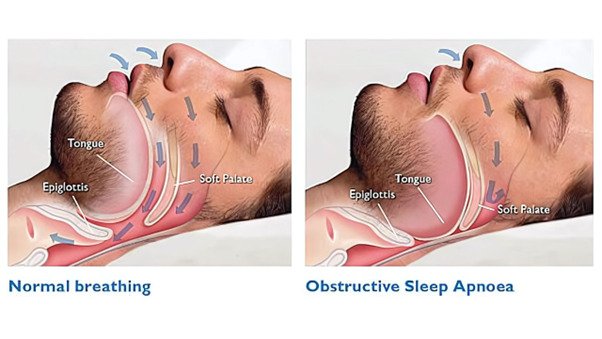 Causes of Obstructive Sleep Apnea